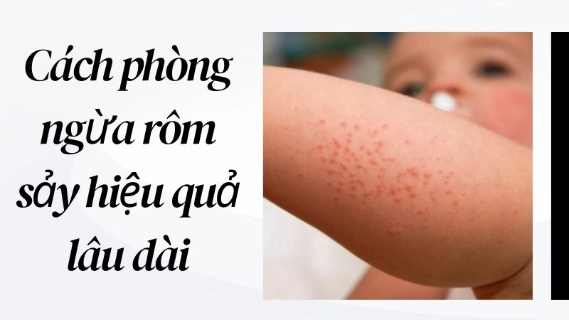Cách phòng ngừa rôm sảy hiệu quả lâu dài
